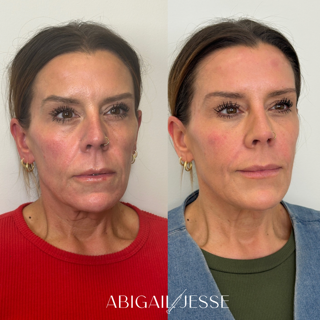 Before and after — facial rejuvenation