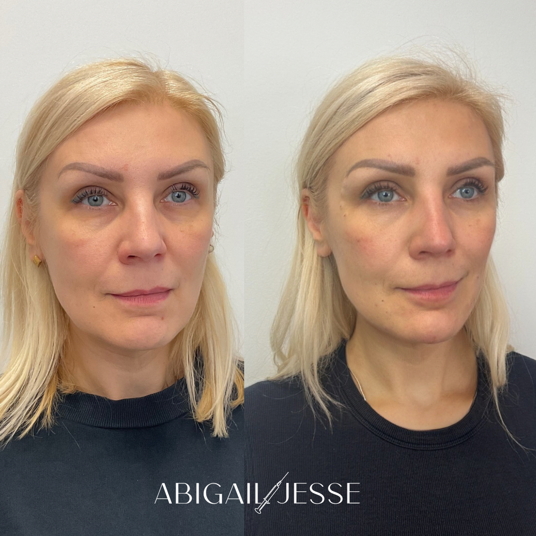 Before and after — injectable treatment