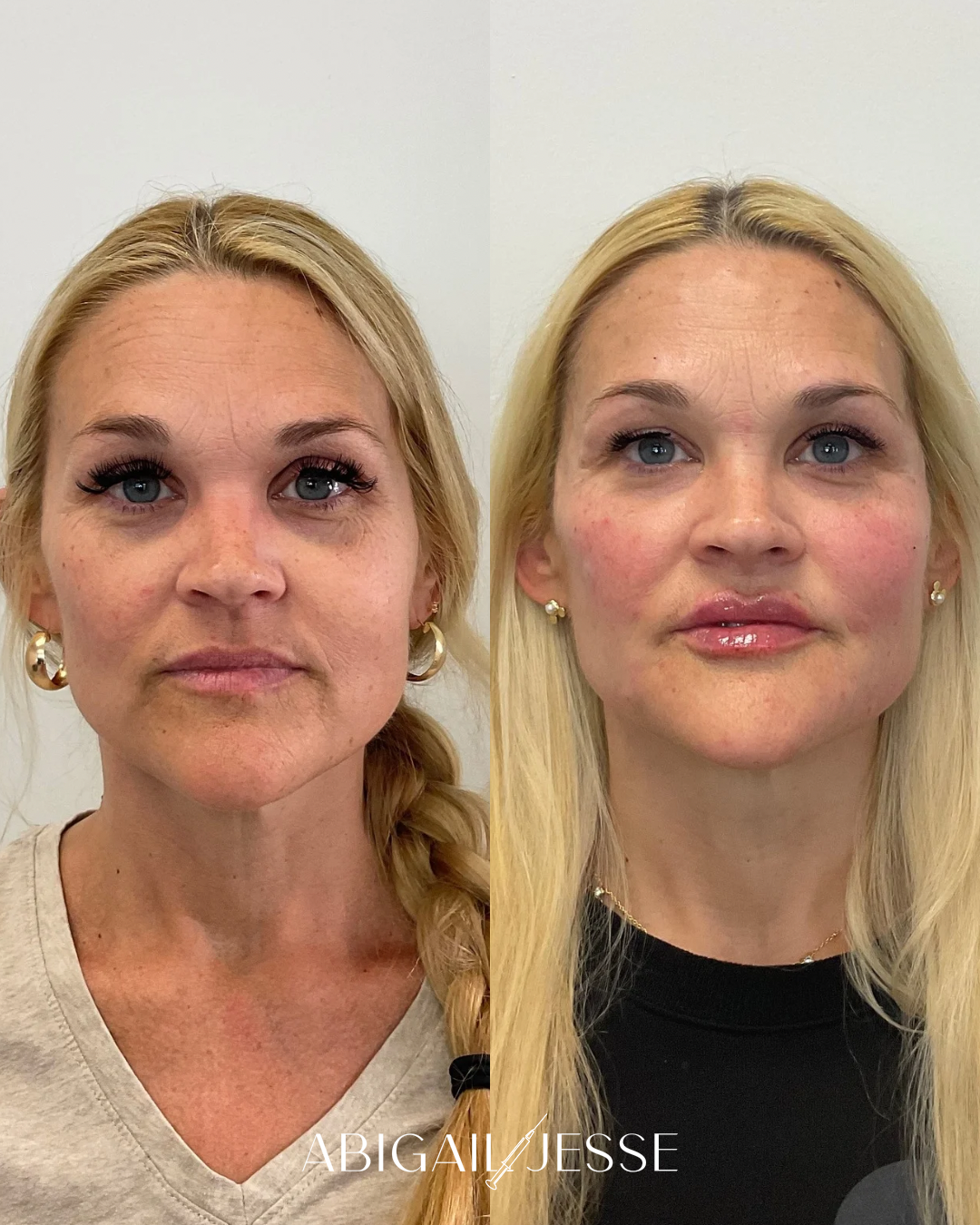 Before and after — filler results