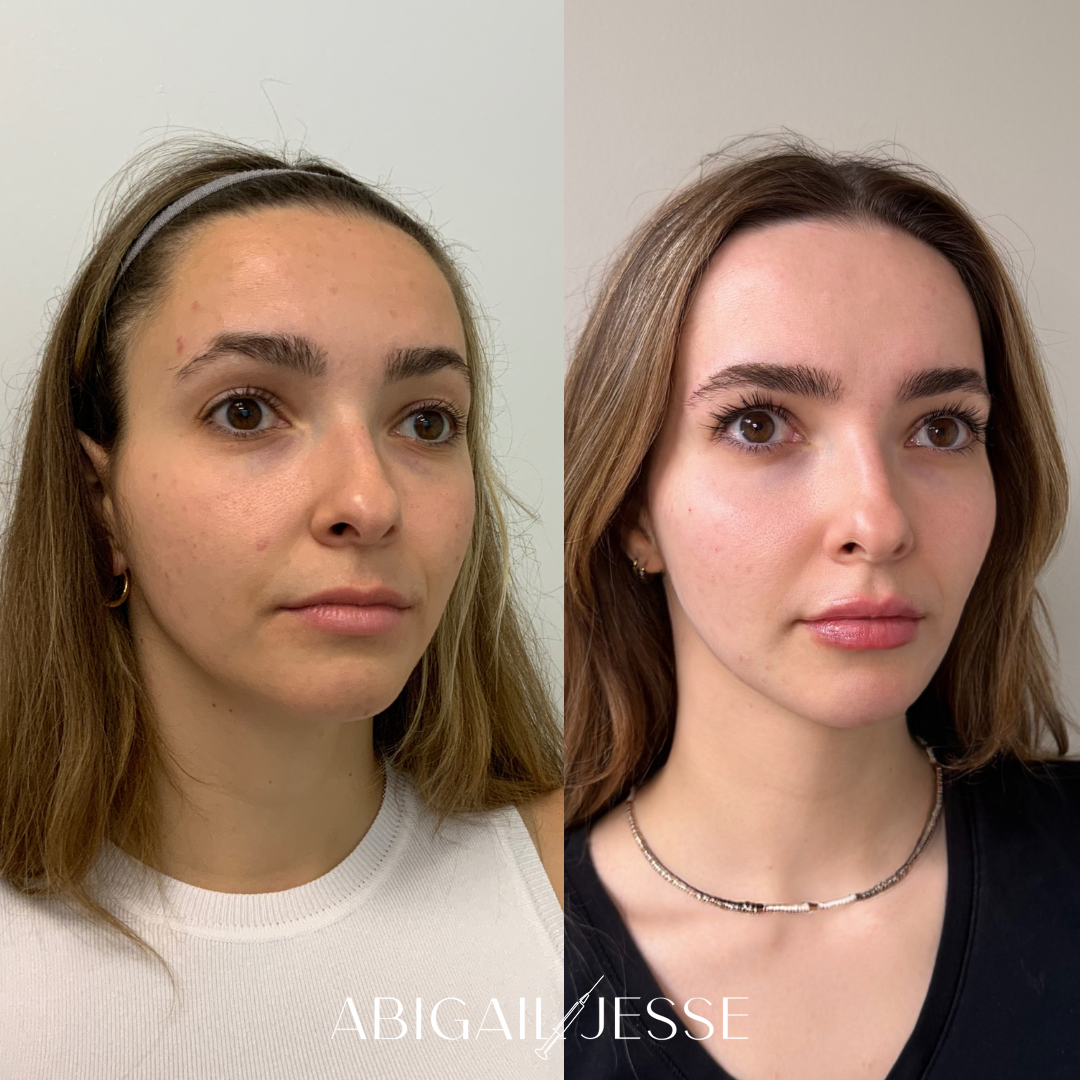 Before and after — neurotoxin treatment