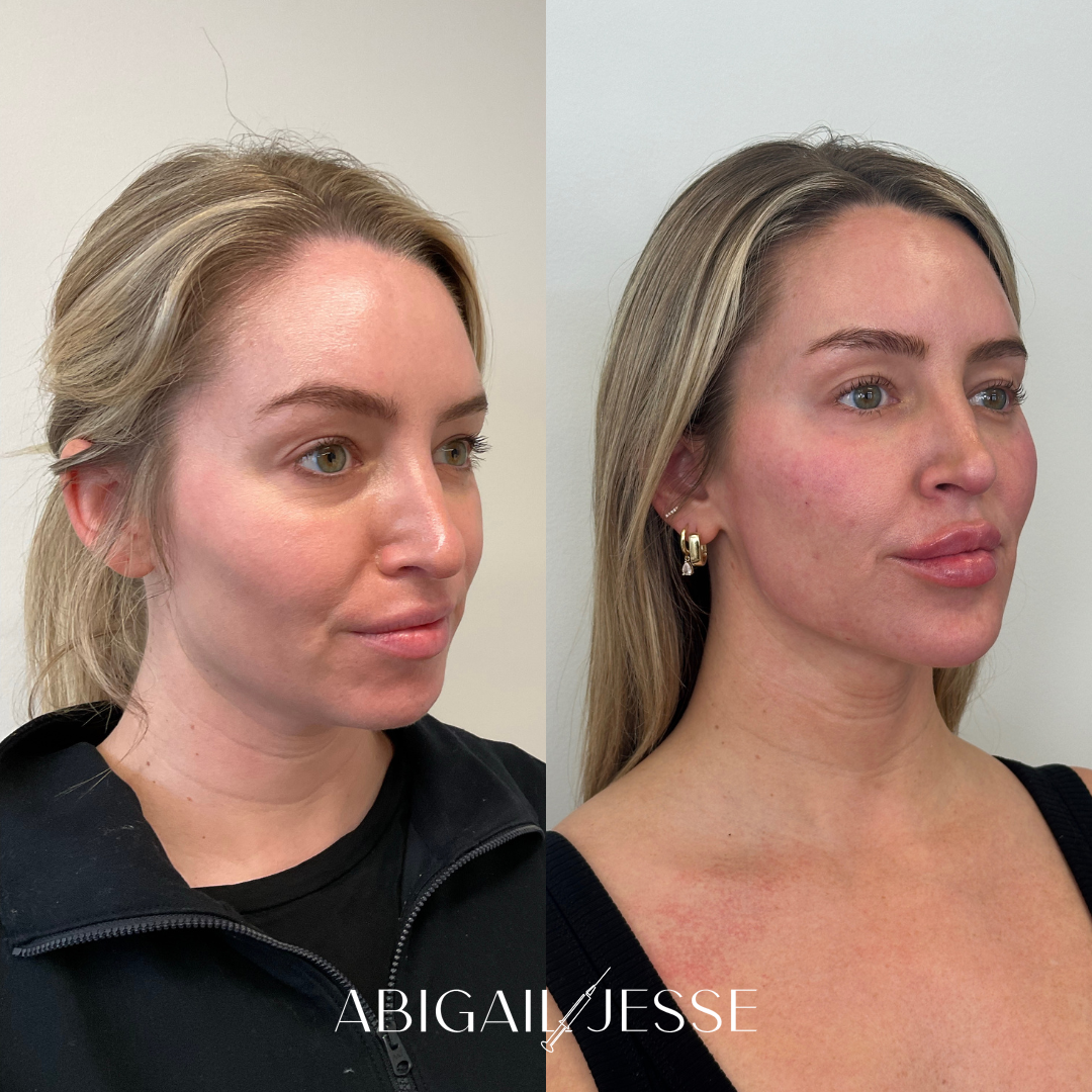 Before and after — facial contouring