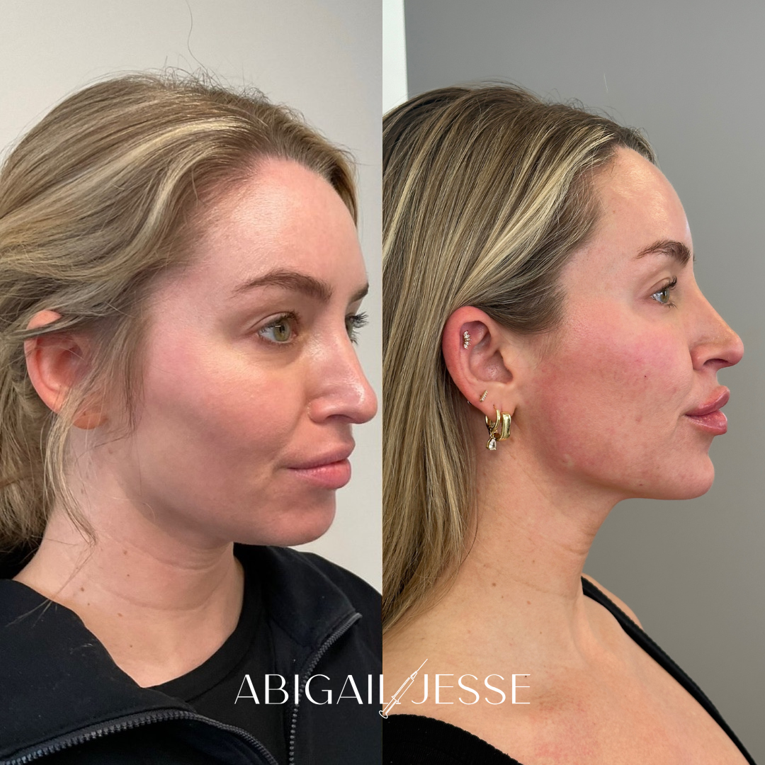 Before and after — aesthetic treatment