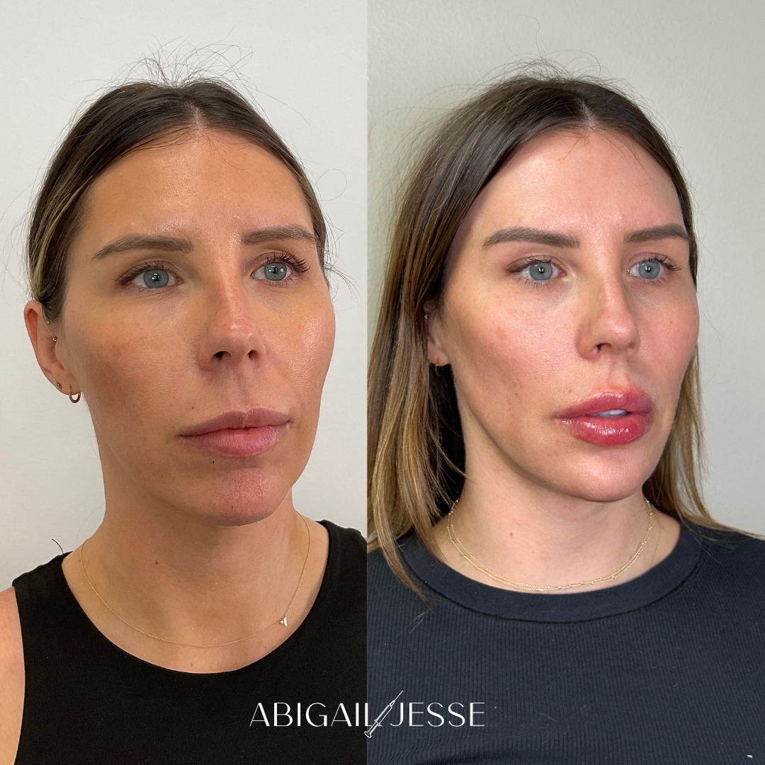 Before and after — injectable results