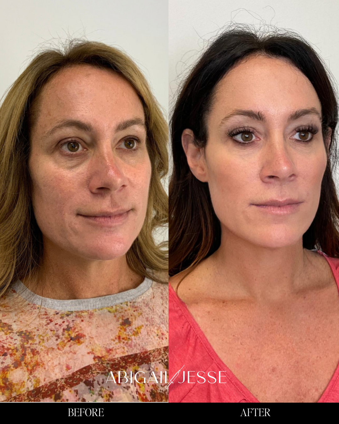 Before and after — full face transformation