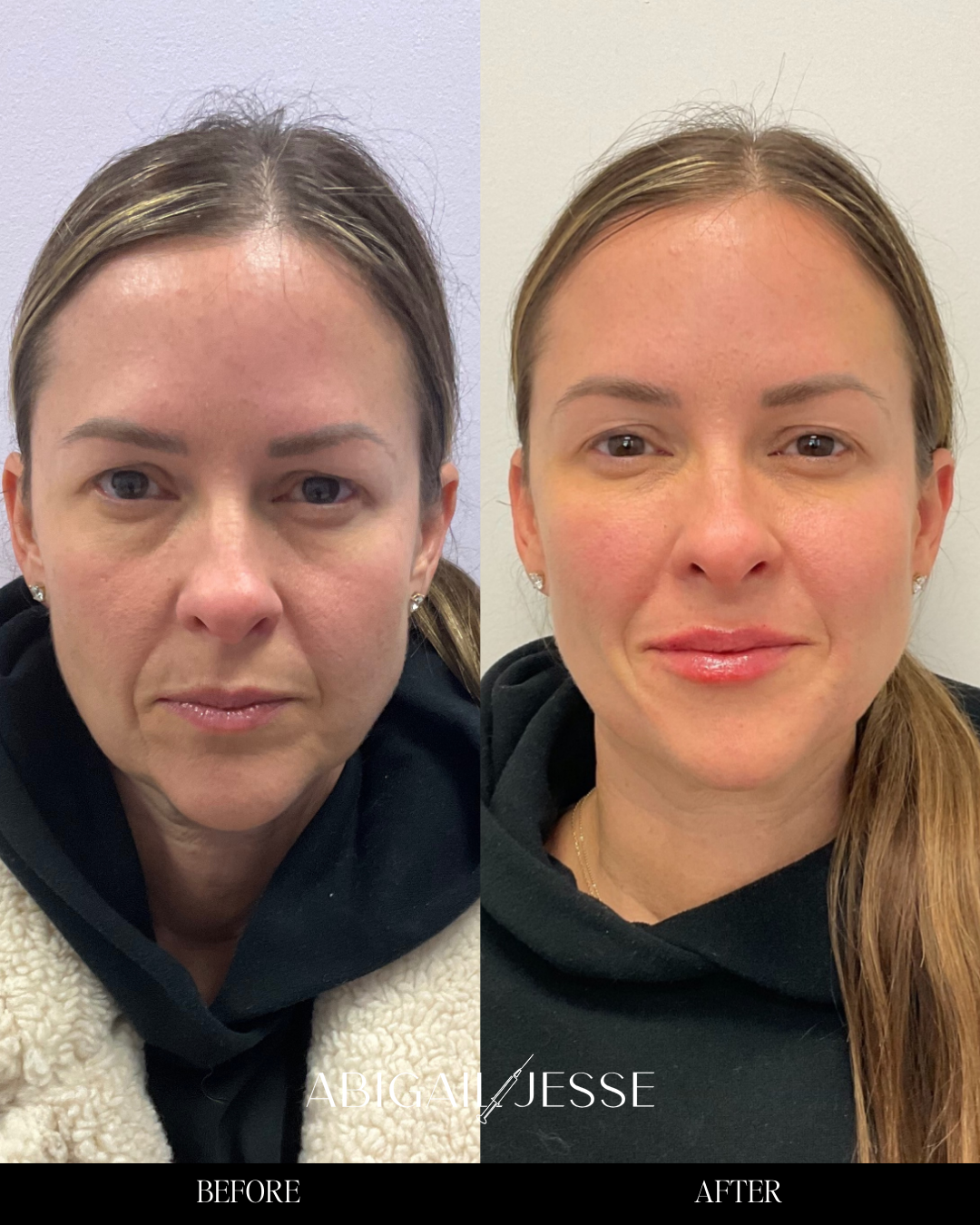 Before and after — facial enhancement