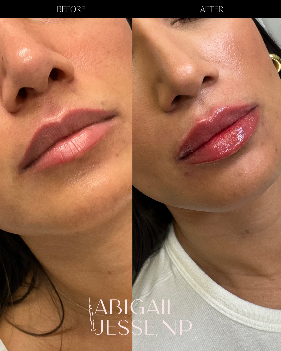 Before and after — aesthetic results