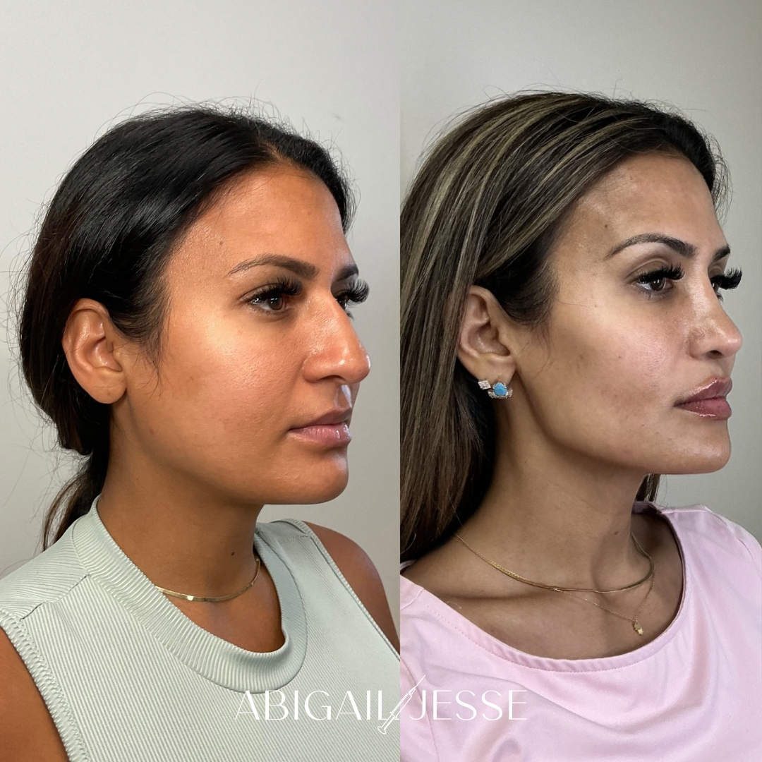 Before and after — facial rejuvenation