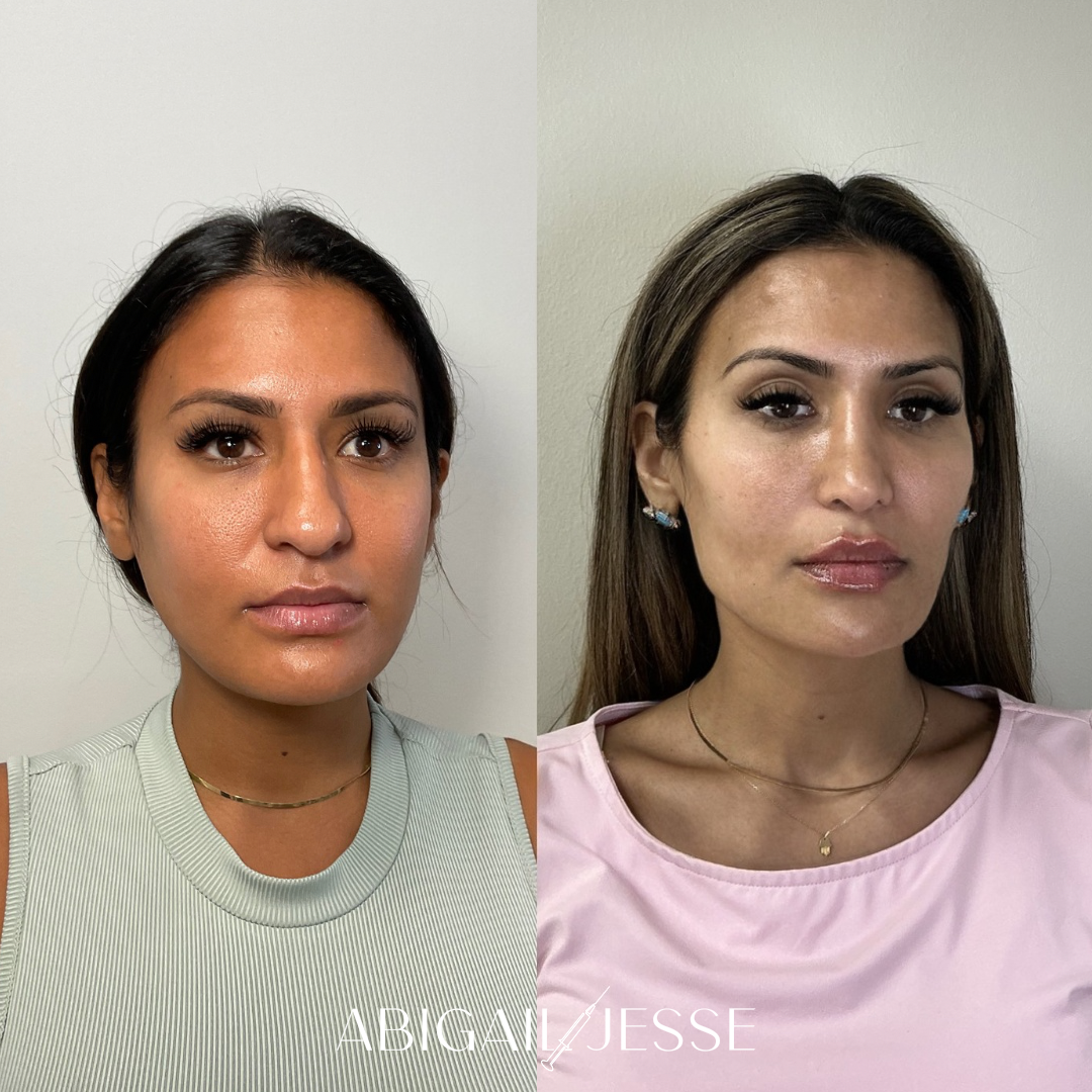 Before and after — injectable results
