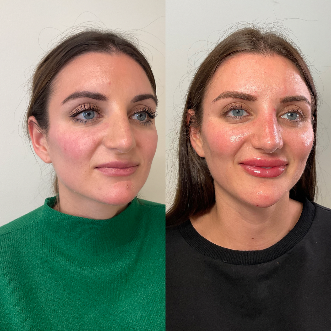 Before and after — facial treatment