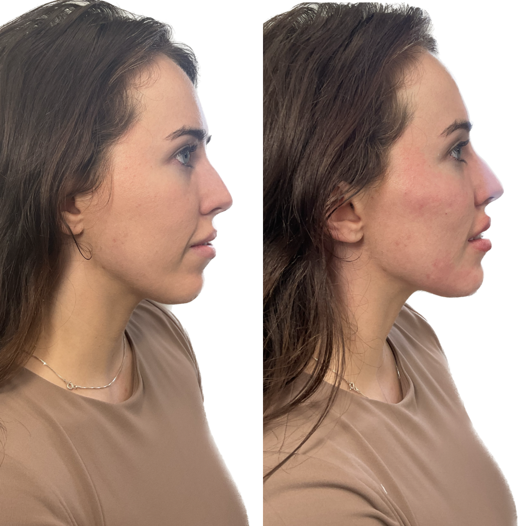 Before and after — profile view results