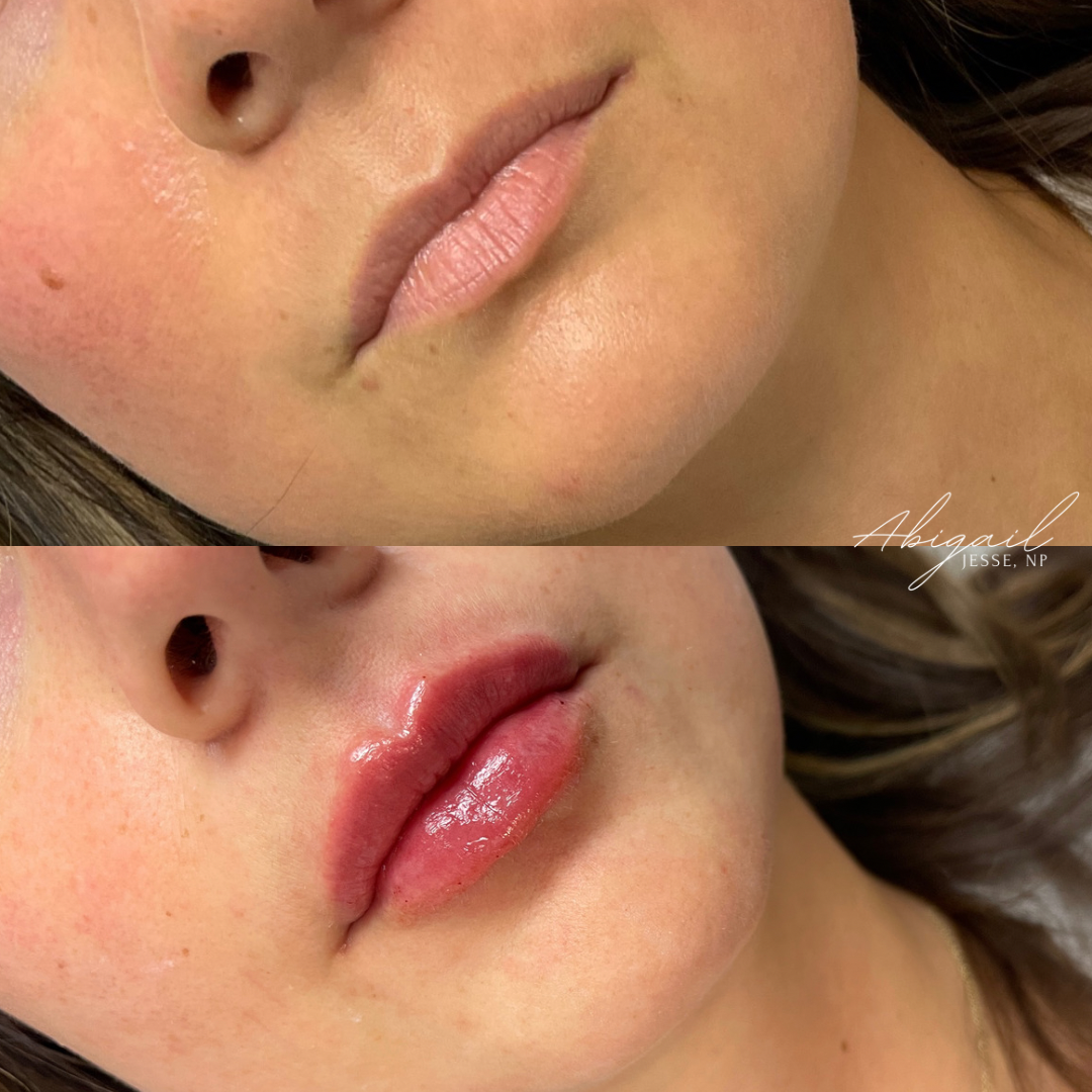 Before and after — lip enhancement