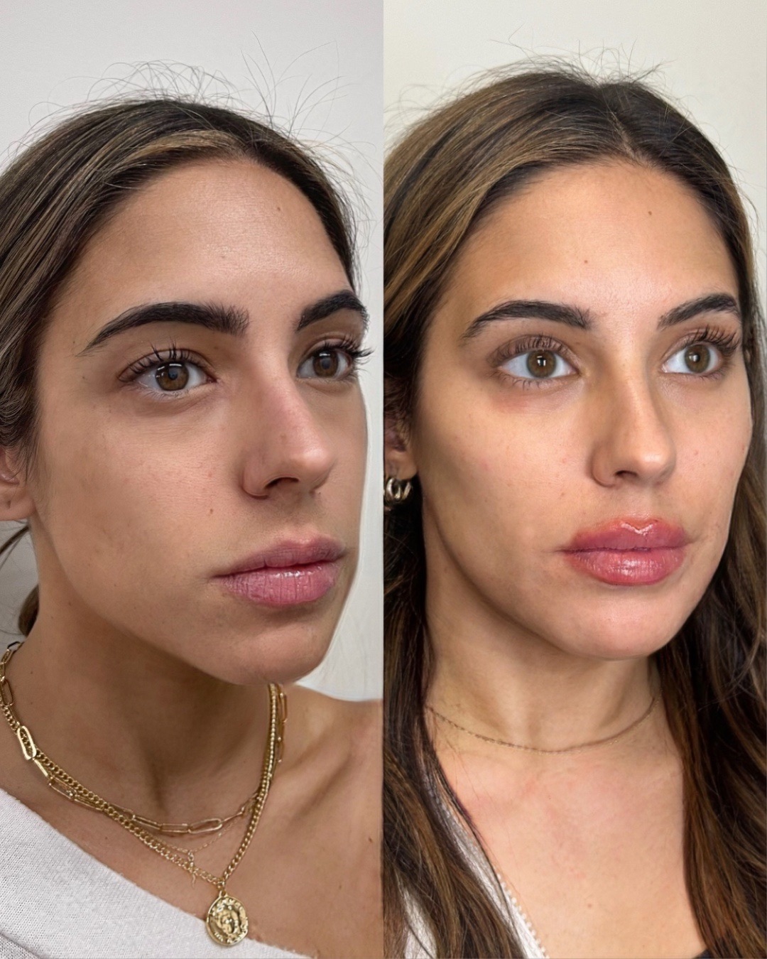 Before and after — angled facial results