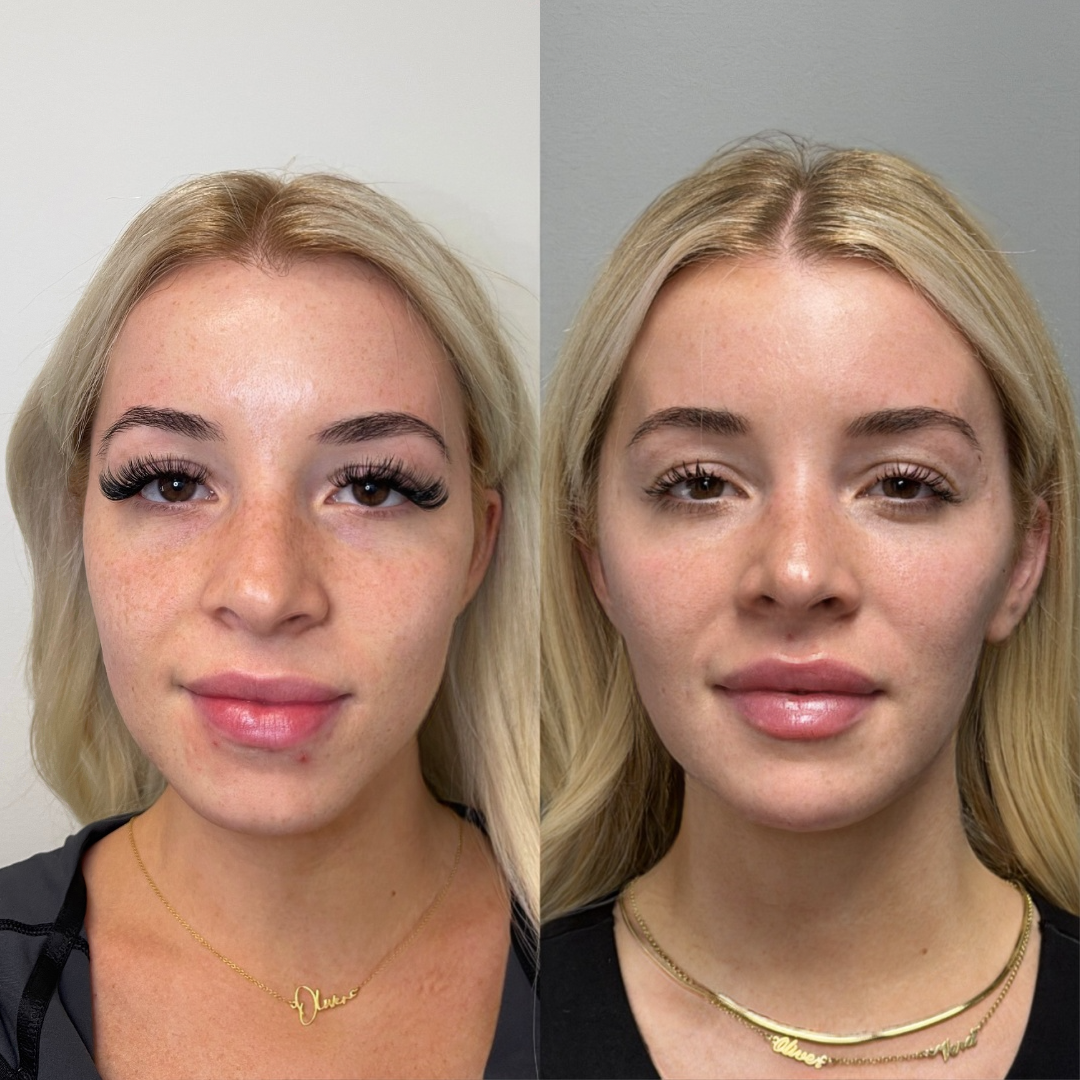 Before and after — facial contouring
