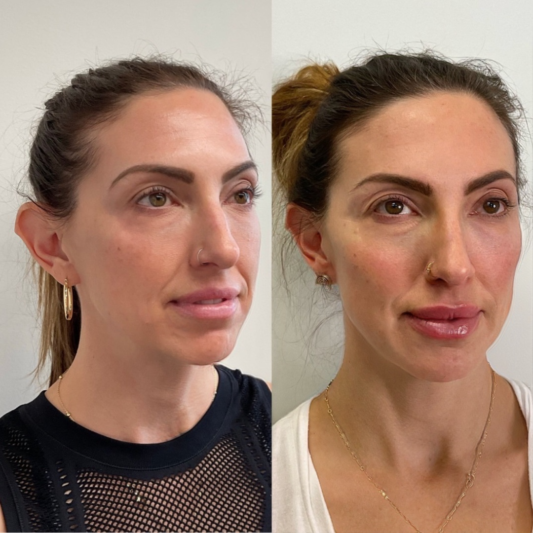 Before and after — aesthetic results