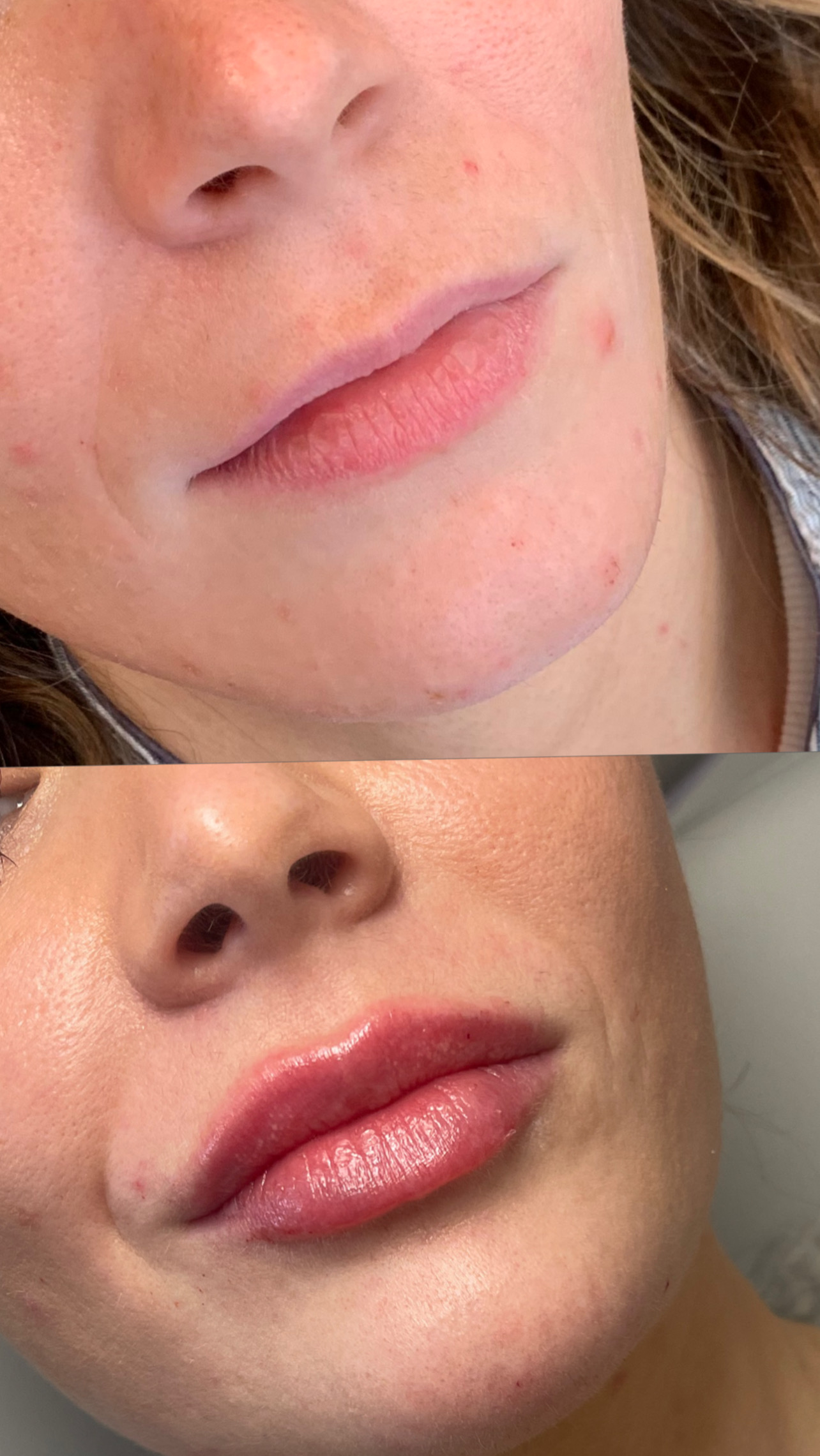 Before and after — lip filler results