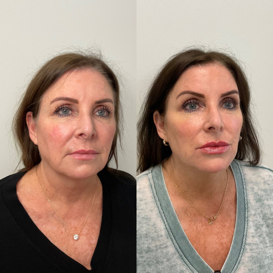 Before and after — full face results