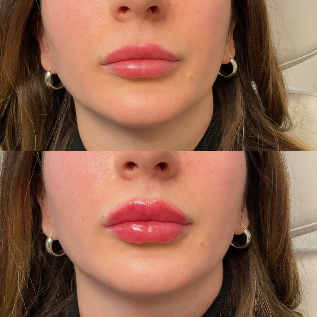 Before and after — lip enhancement results