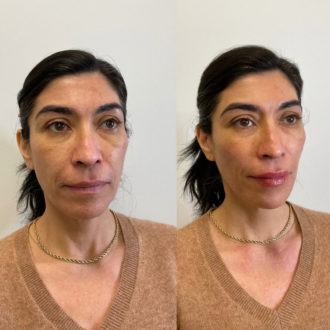 Before and after — facial rejuvenation